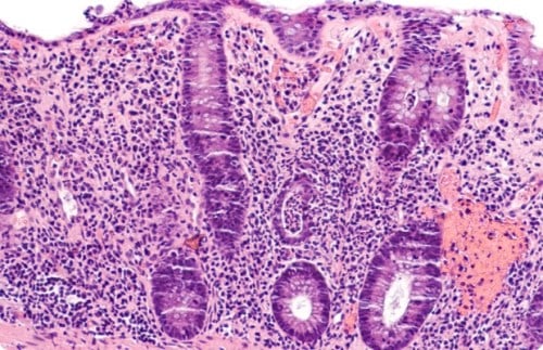 DSS-Induced Colitis